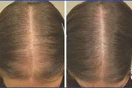 Before and After comparison