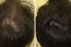 Before and After comparison