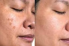 Before and After comparison