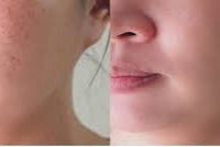 Before and After comparison