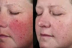 Before and After comparison