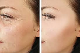 Before and After comparison