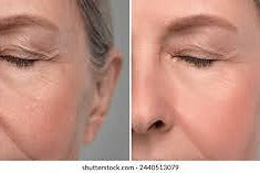 Before and After comparison